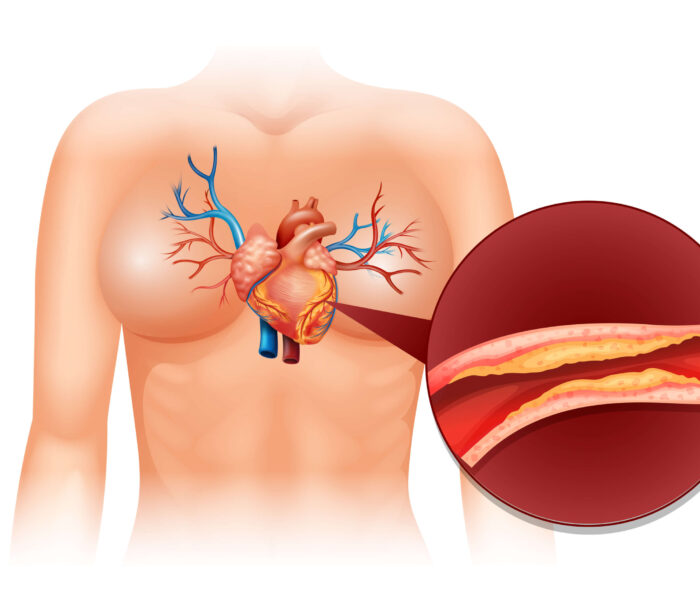 LIPID DISORDERS