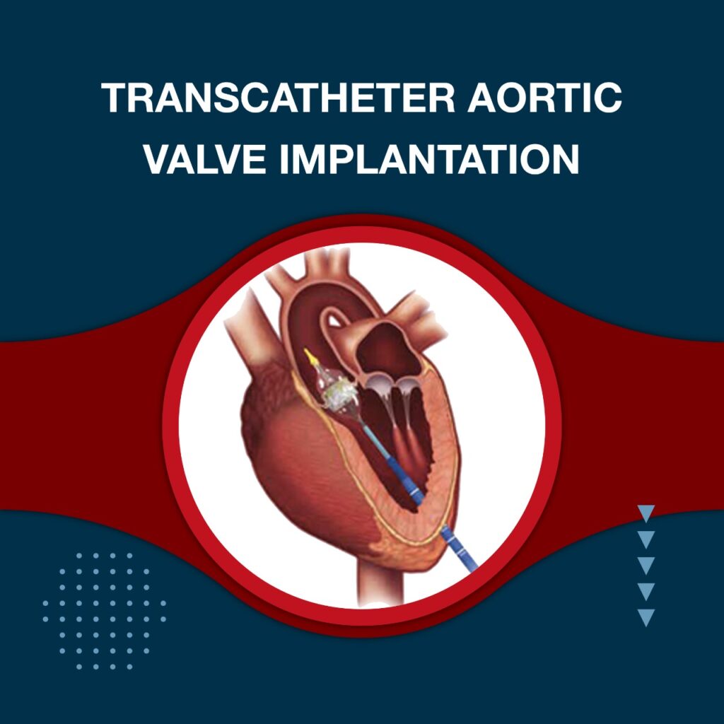Transcatheter Aortic Valve Implantation Tavi In Mumbai