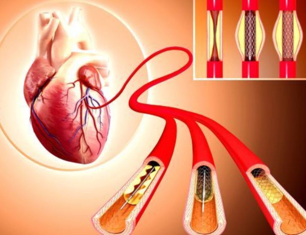 Angioplasty Helps Prevent Heart Attacks|Dr. Rahul Gupta|Cardium