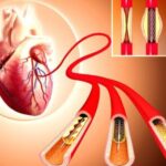 Angioplasty Helps Prevent Heart Attacks|Dr. Rahul Gupta|Cardium