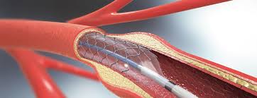 Illustration showing a coronary angioplasty procedure with a balloon and stent opening a blocked heart artery