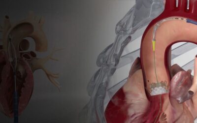 TAVI TAVR heart valve replacement procedure without open heart surgery