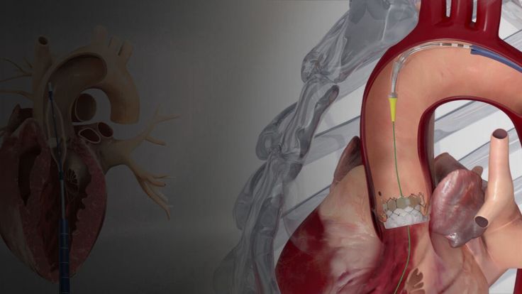 TAVI TAVR heart valve replacement procedure without open heart surgery