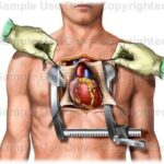 TAVI vs open heart surgery comparison for heart valve treatment