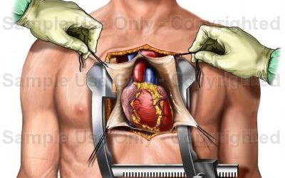 TAVI vs open heart surgery comparison for heart valve treatment