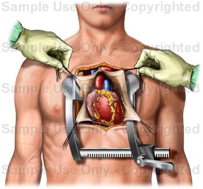 TAVI vs open heart surgery comparison for heart valve treatment