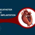 Doctor explaining TAVR non-surgical heart valve replacement procedure to a heart patient at Cardium Heart Care Clinic.