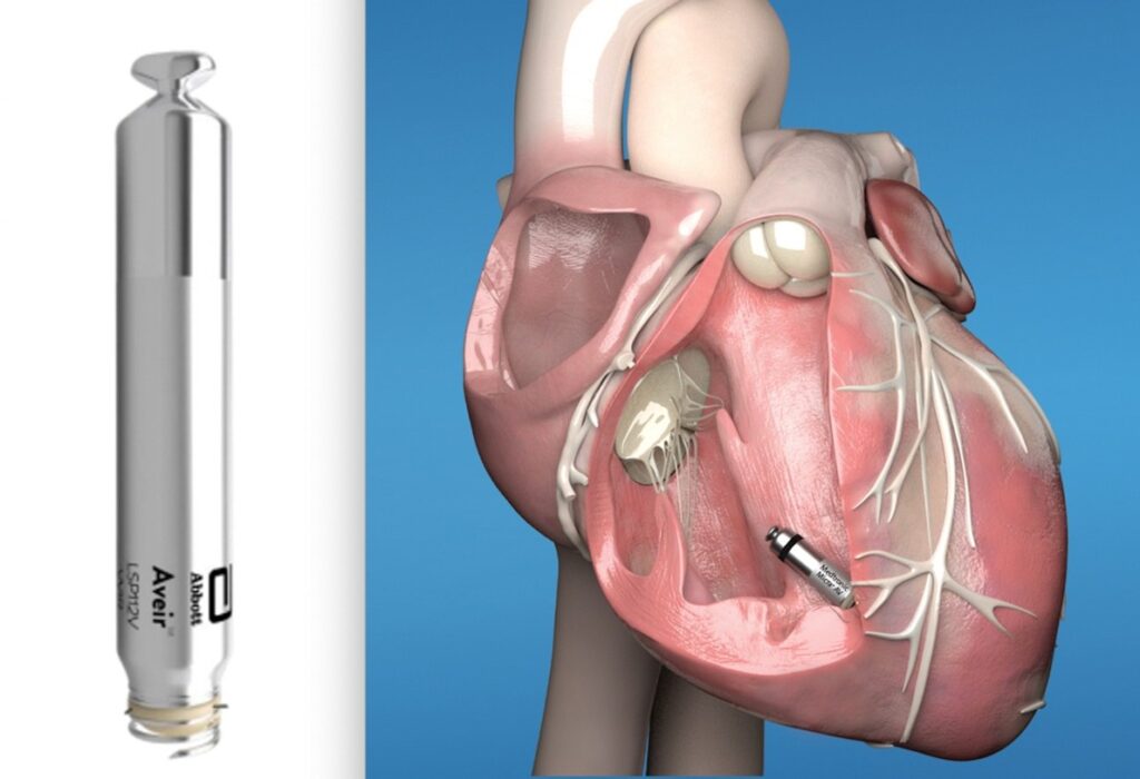 Cardiologist demonstrating a leadless pacemaker device next to a heart model illustrating modern wireless cardiac pacing technology