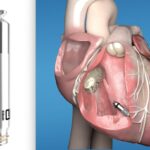Cardiologist demonstrating a leadless pacemaker device next to a heart model illustrating modern wireless cardiac pacing technology