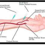 Cardiologist performing radial angiography through the wrist artery for a minimally invasive heart examination.