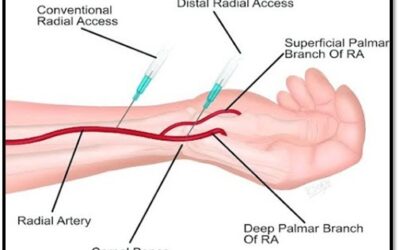 Cardiologist performing radial angiography through the wrist artery for a minimally invasive heart examination.