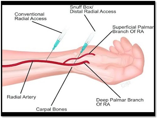 Cardiologist performing radial angiography through the wrist artery for a minimally invasive heart examination.